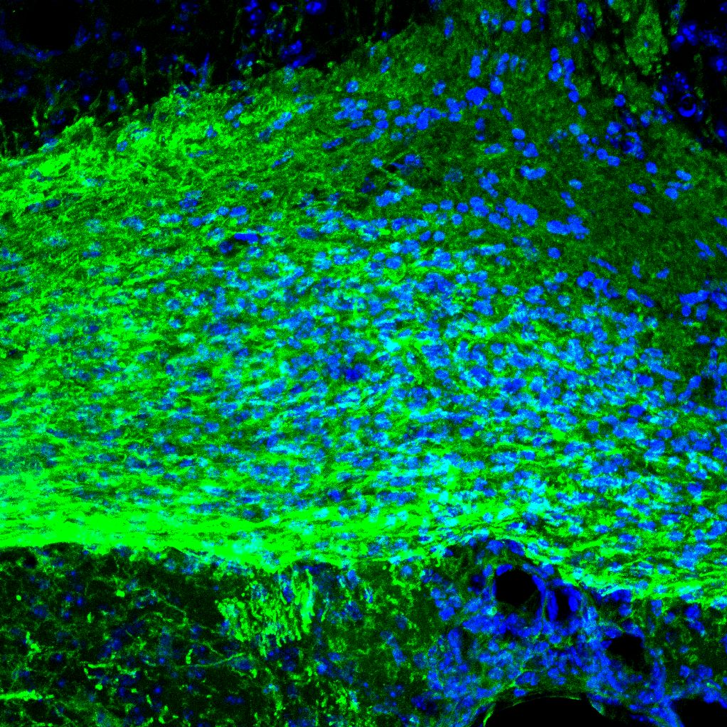 Sclerosi multipla: nuova luce sul ruolo della microglia  nella riparazione della mielina